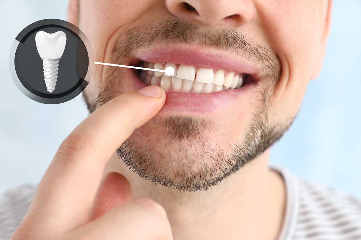GPS Dental | Dental Implants GPS Dental | Dental Implants